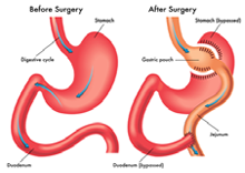 Top Notch Gastric Bypass Surgery in Guangzhou, China_220x156