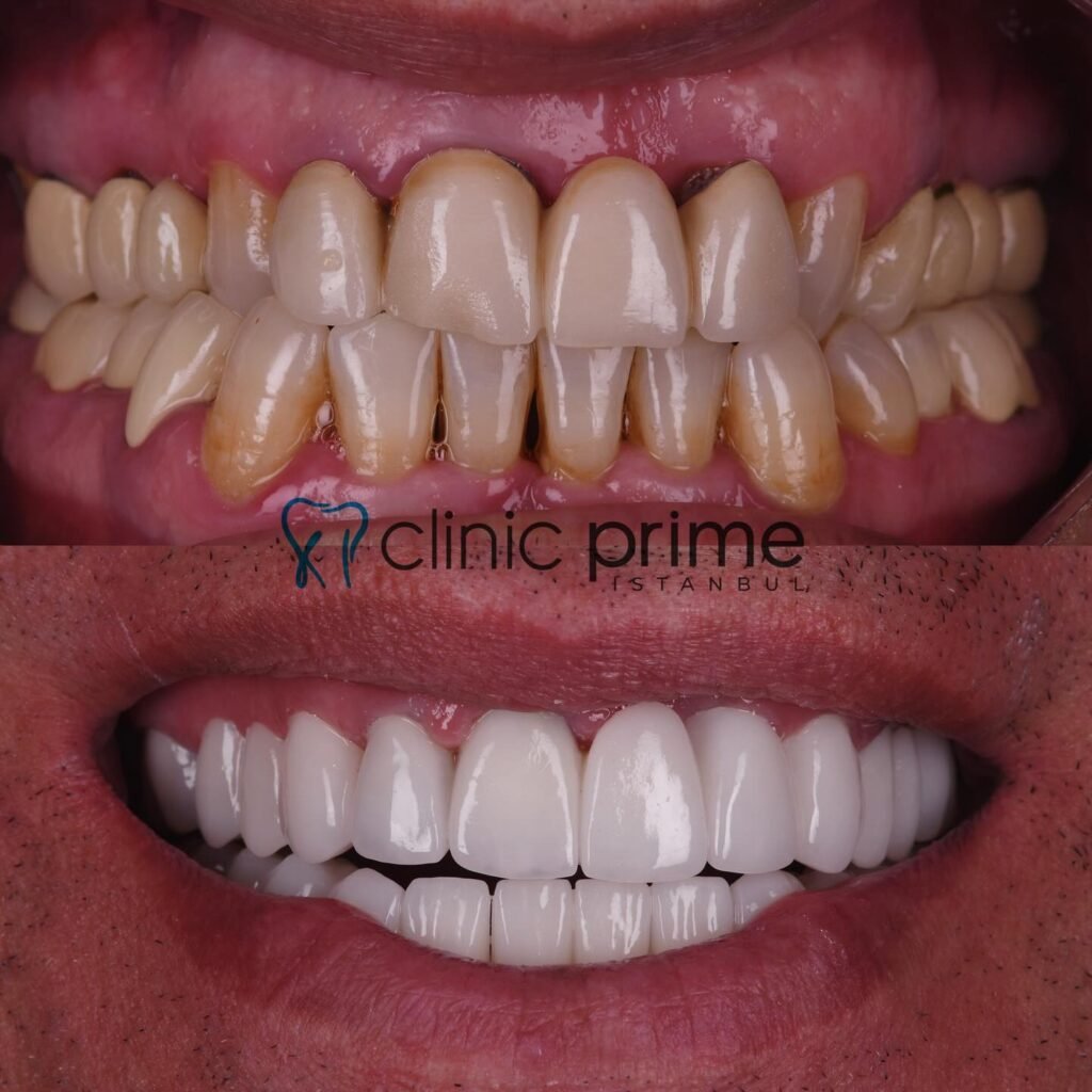 Before and After Cosmetic Dentistry in Istanbul, Turkey