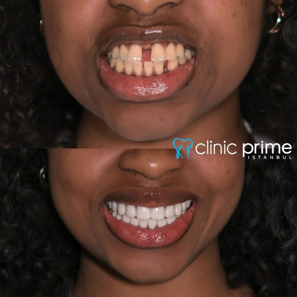 Before and After Dental Implants in Istanbul, Turkey