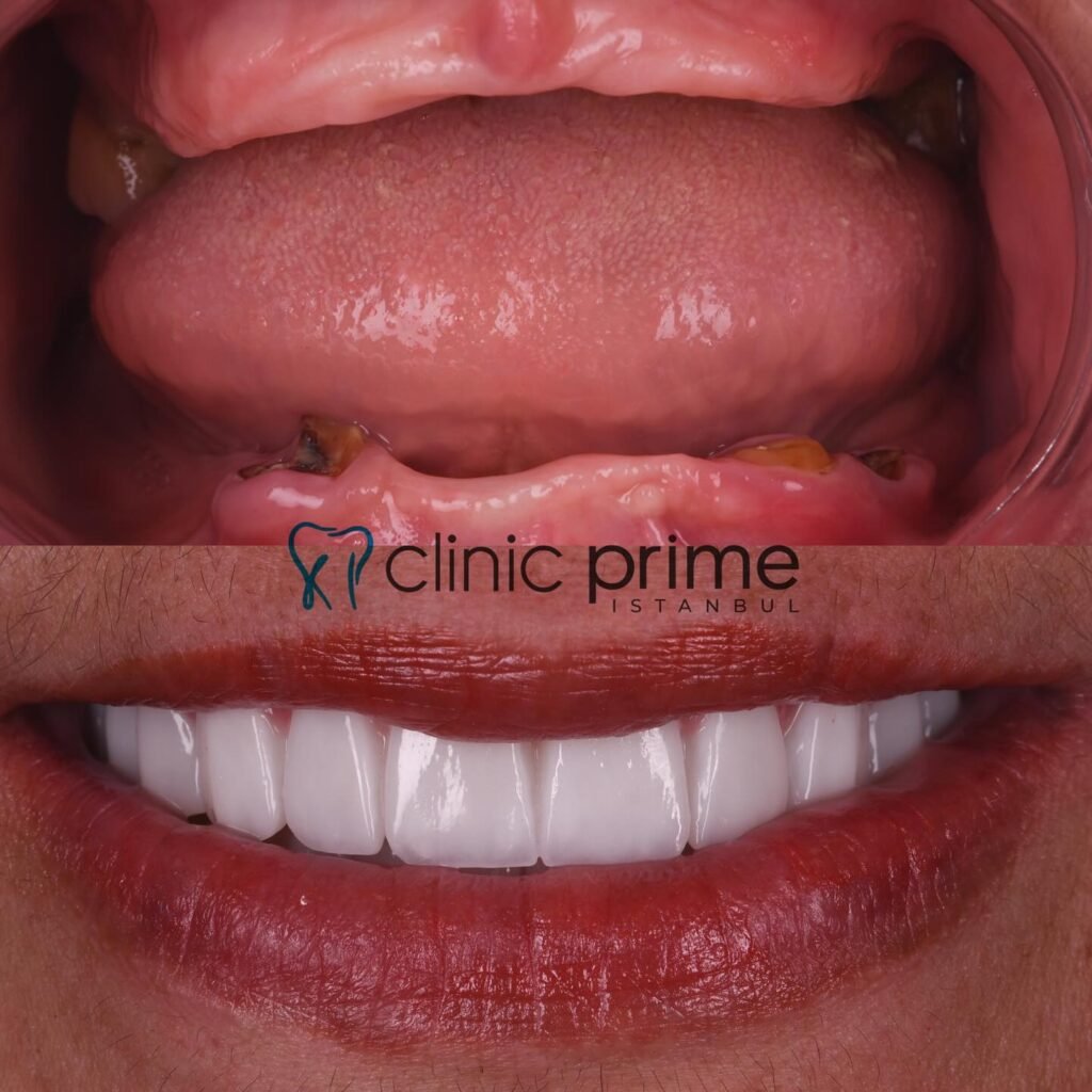 Before and After Full Mouth Reconstruction in Istanbul, Turkey