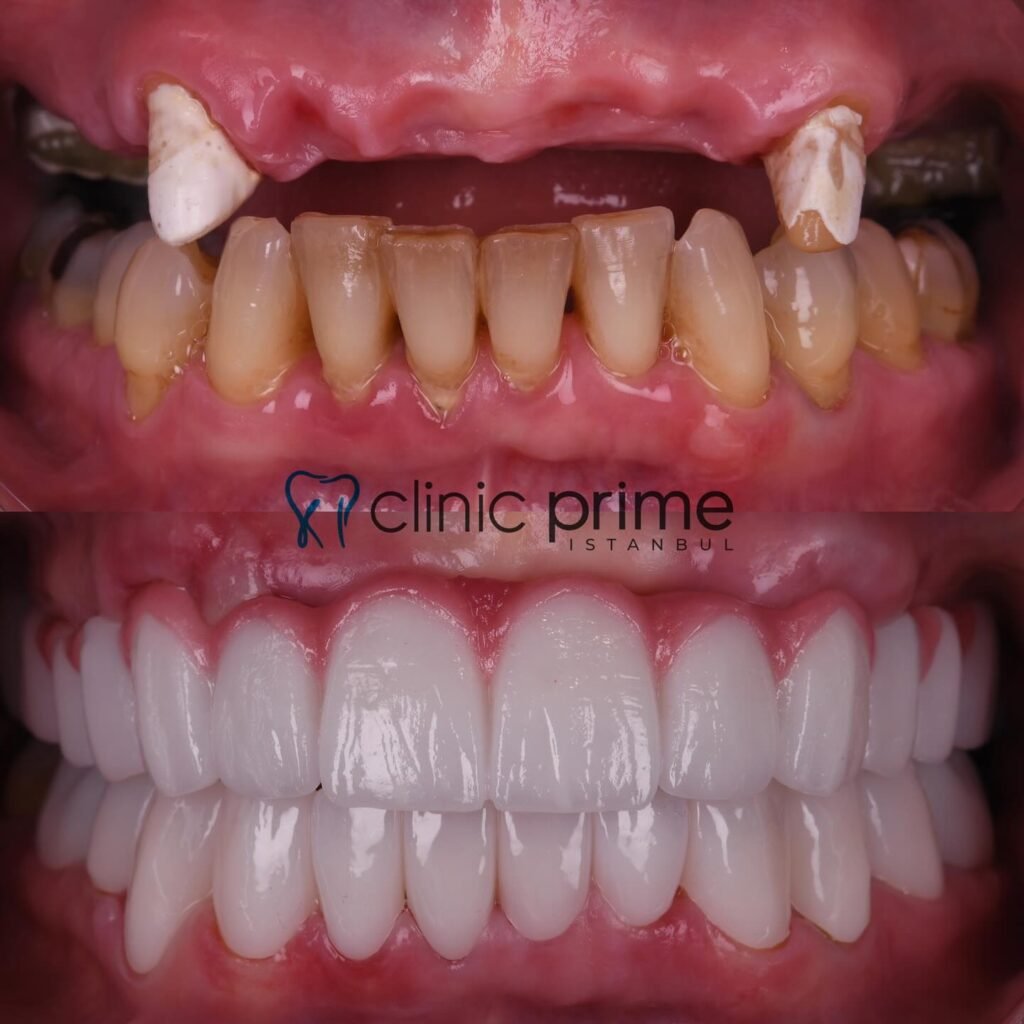 Before and After Smile Makeover in Istanbul, Turkey